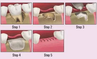 illustration of the steps of a bone graft