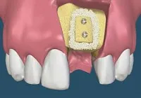 illustration of small screws used in a bone graft
