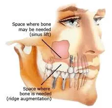 illustration of a face showing space where a sinus lift may be needed