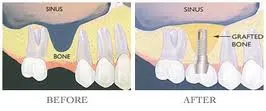 illustration showing before and after a bone graft