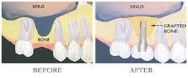 illustration showing before and after a bone graft