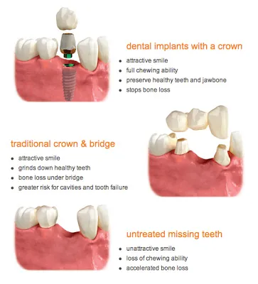 illustration showing Dental implants vs crows