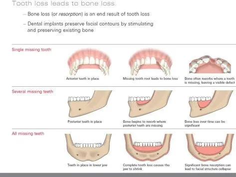illustration showing tooth loss leads to bone loss