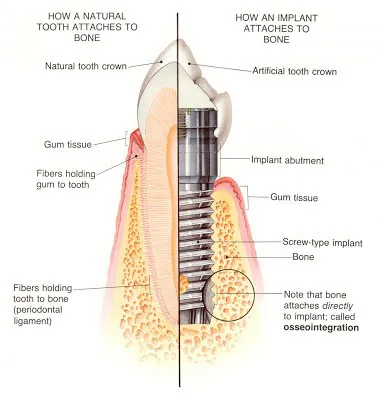 Illustration showing the anatomy of a dental implant