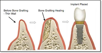 Illustration of a bone graft and implant placed