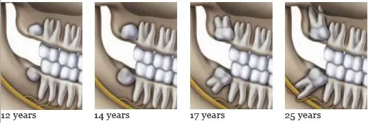 Impacted wisdom tooth progression by age