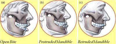 jaw position illustration