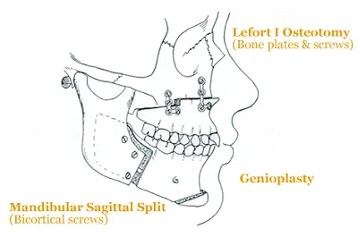 jaw surgery illustration